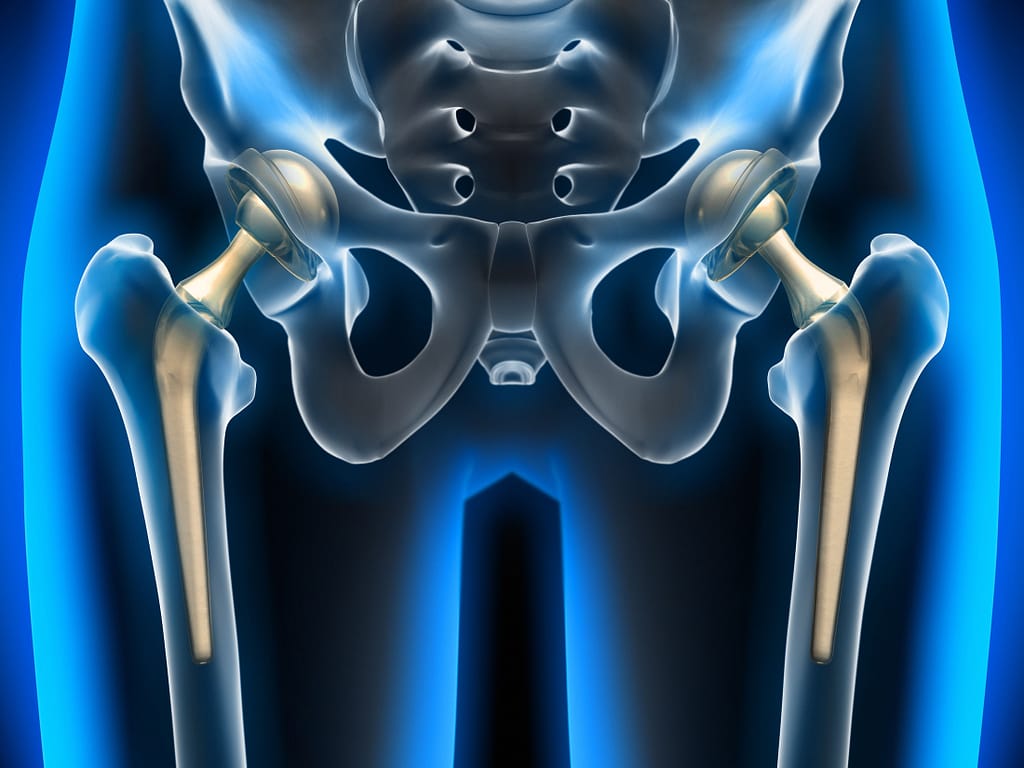 Best Hip Replacement Surgery In Pathankot Hp Orthocare Hospital 0937